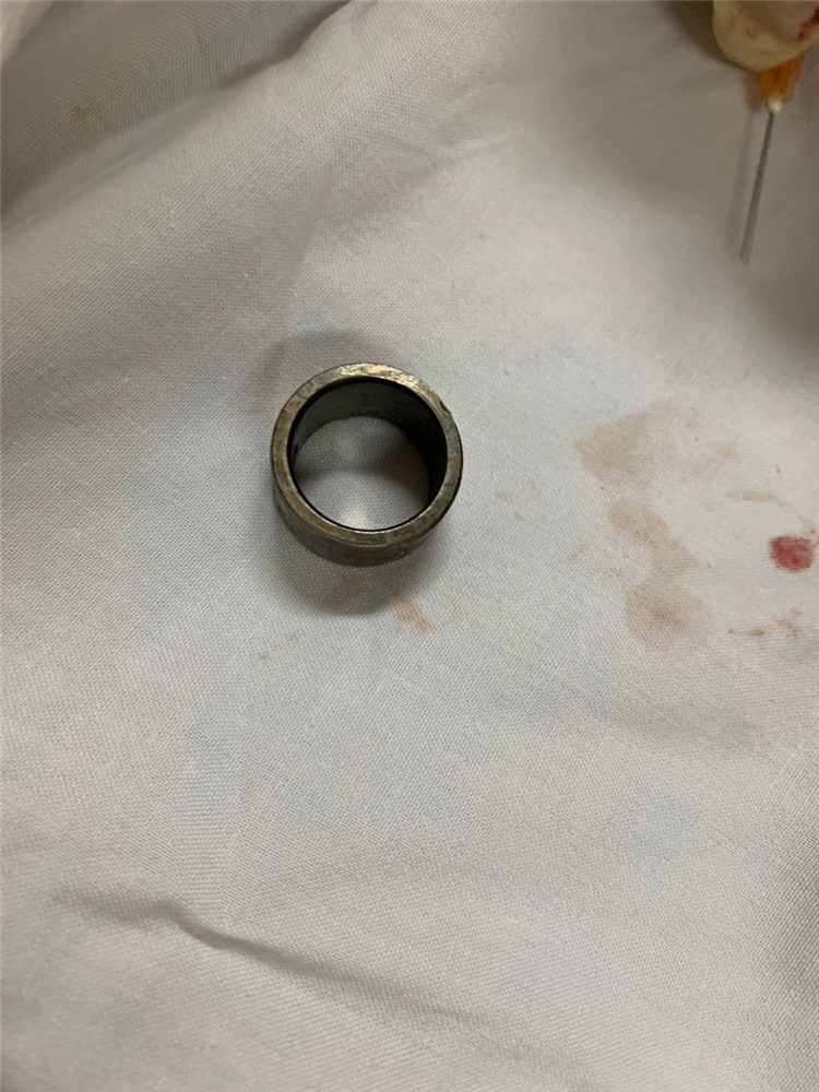 TỰ ĐEO VÒNG VÀO DƯƠNG VẬT ĐỂ CẢI THIỆN ĐỘ CƯƠNG CỨNG, NGƯỜI ĐÀN ÔNG SUÝT MẤT DƯƠNG VẬT